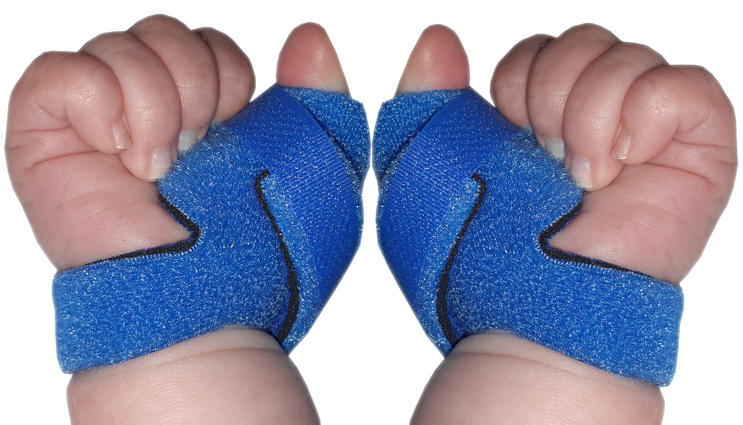 Infant Neonatal Thumb Splint for Cerebral Palsy, Stroke, M.S, Injury ...