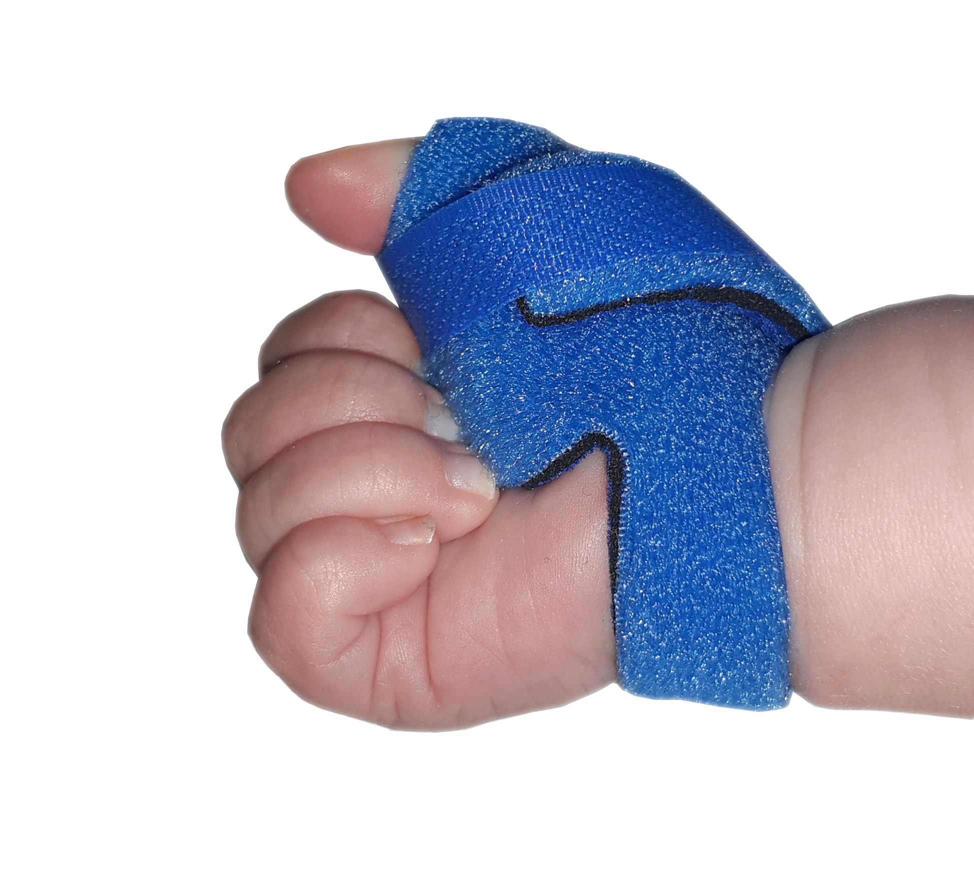 Infant Neonatal Thumb Splint for Cerebral Palsy, Stroke, M.S, Injury ...